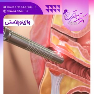 واژینوپلاستی