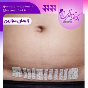 زایمان سزارین