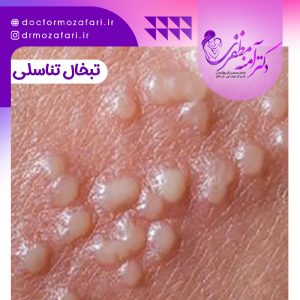 تبخال تناسلی