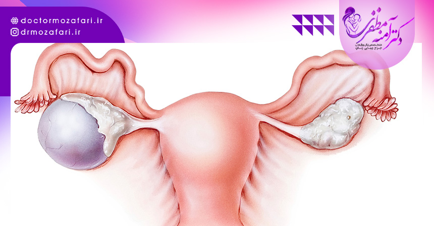علائم تنبلی تخمدان