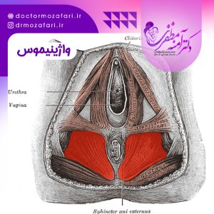 درمان واژینیسموس