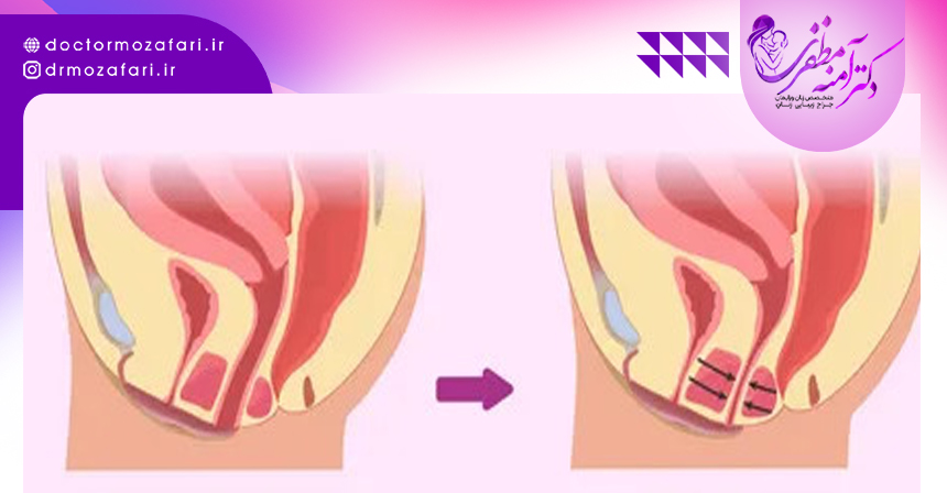 روش های درمان واژینیسموس