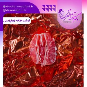 گوشت اضافه بعد از لابیاپلاستی