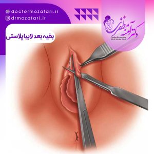 بخیه بعد از لابیاپلاستی