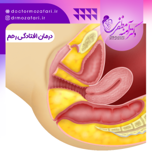 درمان افتادگی رحم