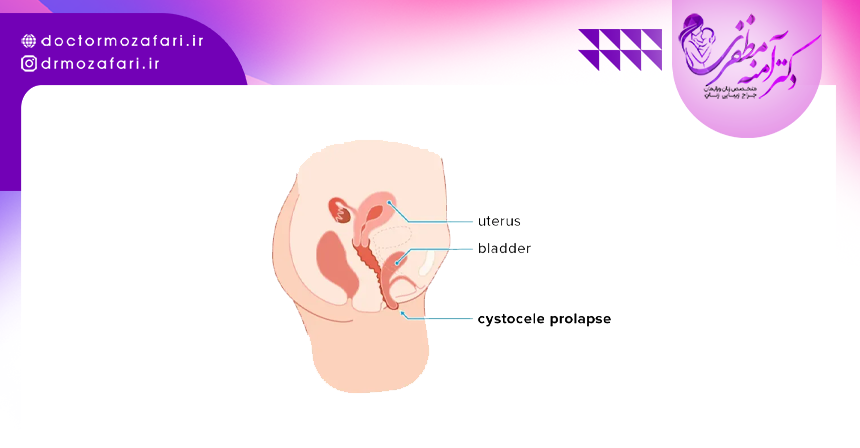 مشاوره و حمایت روانی برای درمان افتادگی رحم