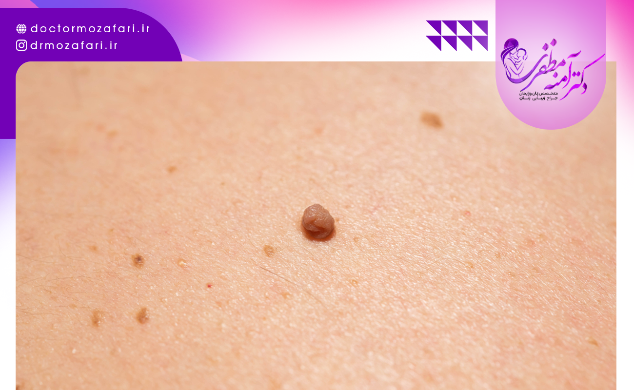 روش های تشخیص زگیل تناسلی