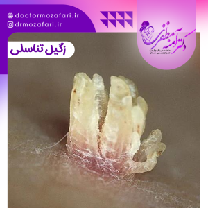 زگیل تناسلی چیست؟