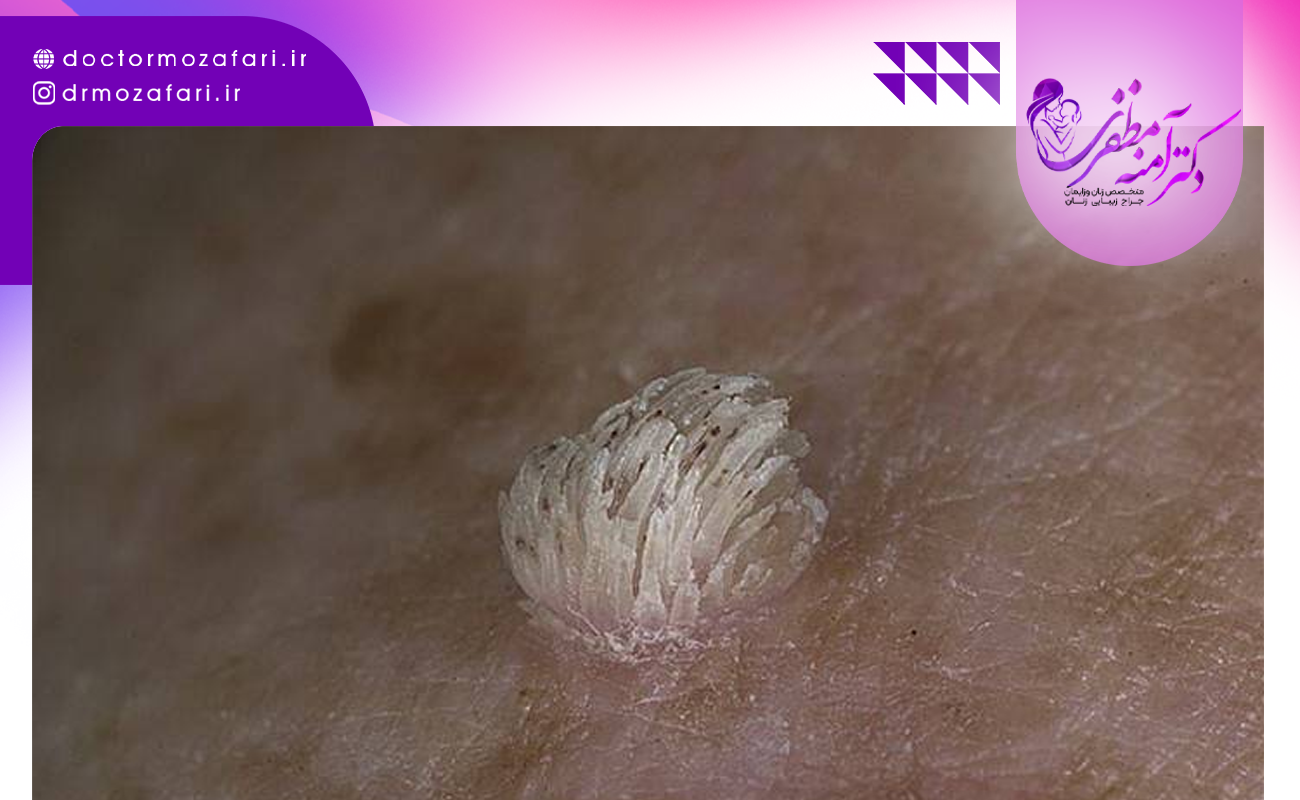 انواع زگیل تناسلی و علائم آن