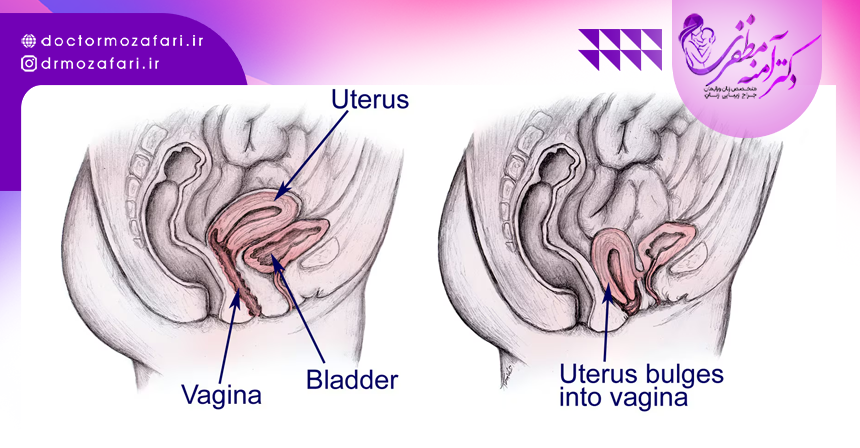 جراحی برای درمان افتادگی رحم